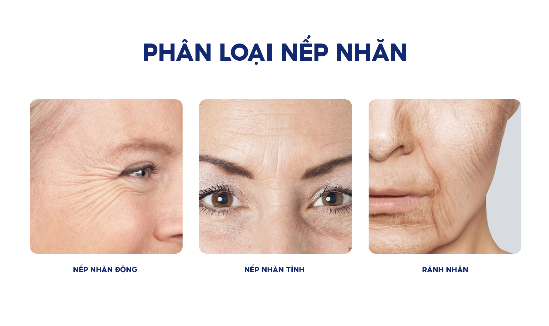 Giảm Nếp Nhăn: Hướng Dẫn Từ A đến Z Để Làn Da Luôn Trẻ Trung cam-nang-lam-dep - 1
