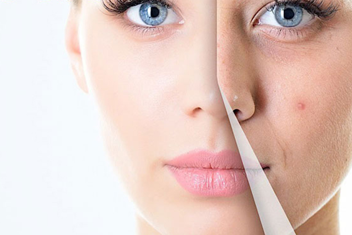 Cách Trị Mụn Hiệu Quả Tại Nhà – Bí Quyết Cho Làn Da Sáng Khỏe