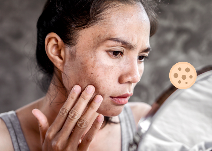 Tại lại bị nám và tàn nhang? Top kem trị nám Thái hiệu quả nhất thị trường hiện nay