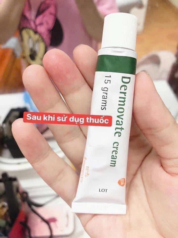 Kem bôi vảy nến Dermova te Thái Lan 15g-1