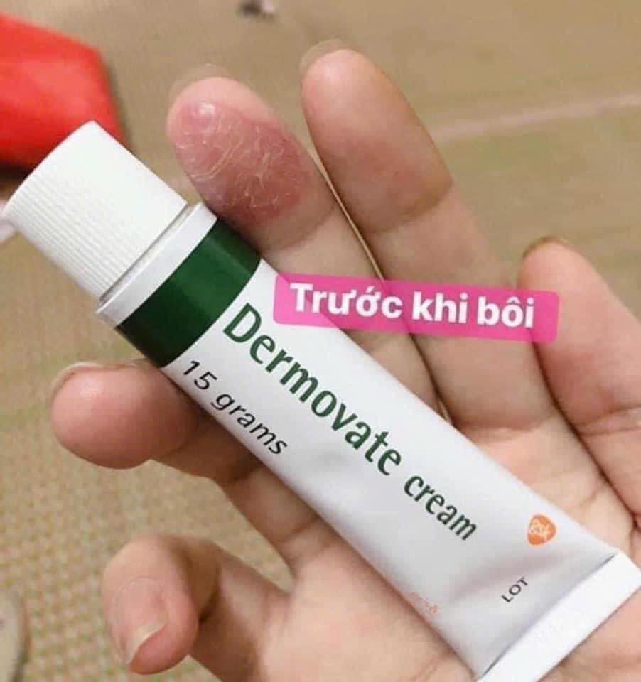 Kem bôi vảy nến Dermova te Thái Lan 15g-2